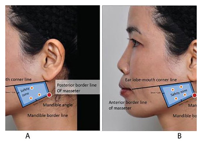 การดูแลใบหน้าเพื่อให้ใบหน้าเรียว ทำอย่างไรได้บ้าง “หมอคะ ทำไมไปฉีด #โบท็อกกราม #หน้าเรียวแล้ว ไม่เห็นหน้าเรียวเลยคะ” เป็นคำถามที่หมอถูกถามบ่อยมากๆๆๆ ครับ การดูแลใบหน้าเพื่อให้ใบหน้าเรียว ทำอย่างไรได้บ้าง “หมอคะ ทำไมไปฉีด #โบท็อกกราม #หน้าเรียวแล้ว ไม่เห็นหน้าเรียวเลยคะ” เป็นคำถามที่หมอถูกถามบ่อยมากๆๆๆ ครับ