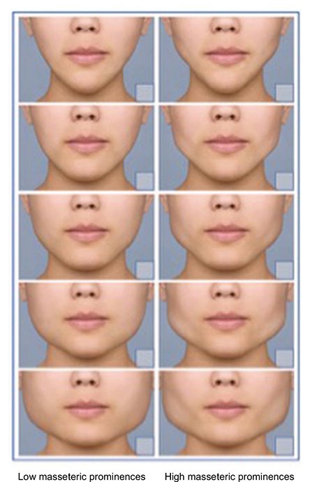 การดูแลใบหน้าเพื่อให้ใบหน้าเรียว ทำอย่างไรได้บ้าง “หมอคะ ทำไมไปฉีด #โบท็อกกราม #หน้าเรียวแล้ว ไม่เห็นหน้าเรียวเลยคะ” เป็นคำถามที่หมอถูกถามบ่อยมากๆๆๆ ครับ การดูแลใบหน้าเพื่อให้ใบหน้าเรียว ทำอย่างไรได้บ้าง “หมอคะ ทำไมไปฉีด #โบท็อกกราม #หน้าเรียวแล้ว ไม่เห็นหน้าเรียวเลยคะ” เป็นคำถามที่หมอถูกถามบ่อยมากๆๆๆ ครับ