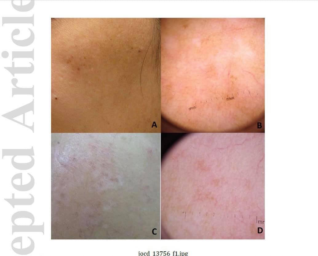 งานวิจัยโดย หมอรุจ, อ. เทอดพงศ์ และทีมงาน เกี่ยวกับการดูแลรักษาฝ้าด้วยการใช้เลเซอร์ งานวิจัยโดย หมอรุจ, อ. เทอดพงศ์ และทีมงาน เกี่ยวกับการดูแลรักษาฝ้าด้วยการใช้เลเซอร์