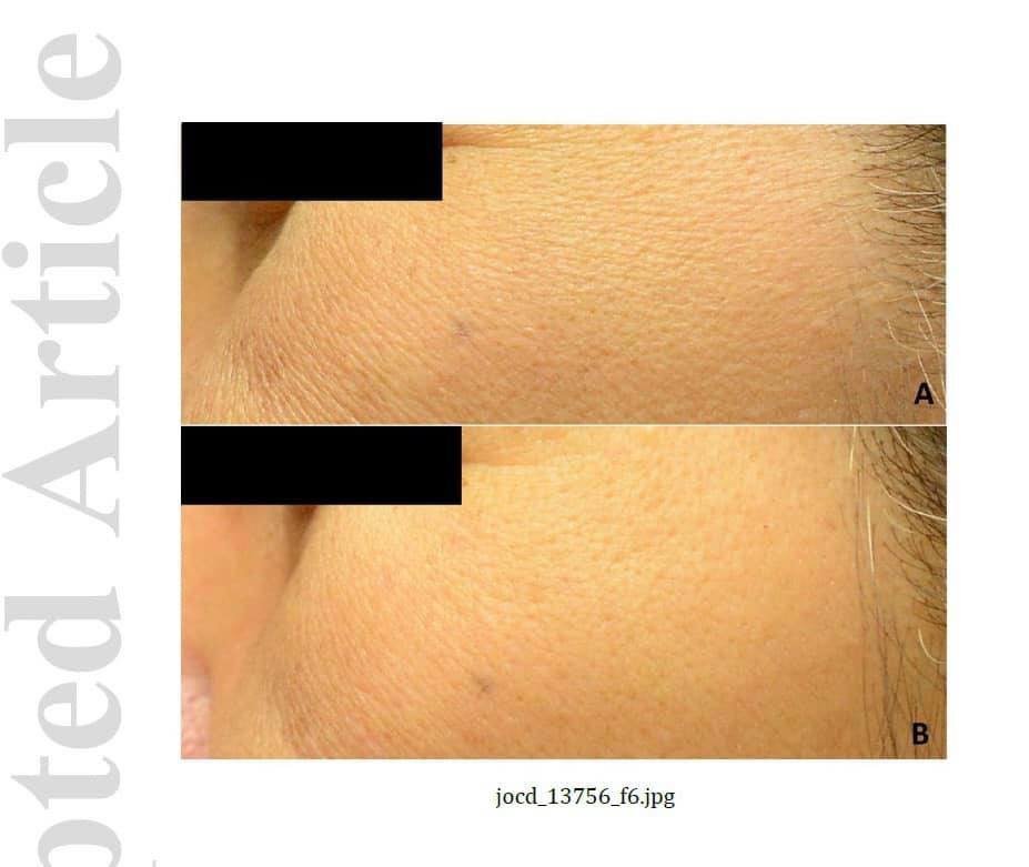 งานวิจัยโดย หมอรุจ, อ. เทอดพงศ์ และทีมงาน เกี่ยวกับการดูแลรักษาฝ้าด้วยการใช้เลเซอร์ งานวิจัยโดย หมอรุจ, อ. เทอดพงศ์ และทีมงาน เกี่ยวกับการดูแลรักษาฝ้าด้วยการใช้เลเซอร์