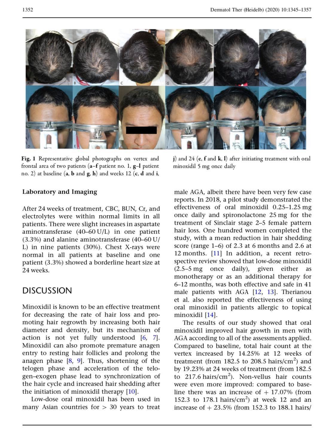 งานวิจัยด้านการดูแลรักษาภาวะผมบางในผู้ชายจากพันธุกรรม โดยการใช้ยาไมน๊อกซิดิวแบบรับทาน รุจ Oral Minoxidil in the Treatment of male AGA โดย ผศ. นพ. ศุภะรุจ เลื่องอรุณ (หมอรุจ) และ รศ.ดร.พญ. รัชต์ธร ปัญจประทีป Oral Minoxidil in the Treatment of male AGA งานวิจัยด้านการดูแลรักษาภาวะผมบางในผู้ชายจากพันธุกรรม โดยการใช้ยาไมน๊อกซิดิวแบบรับทาน รุจ Oral Minoxidil in the Treatment of male AGA โดย ผศ. นพ. ศุภะรุจ เลื่องอรุณ (หมอรุจ) และ รศ.ดร.พญ. รัชต์ธร ปัญจประทีป Oral Minoxidil in the Treatment of male AGA