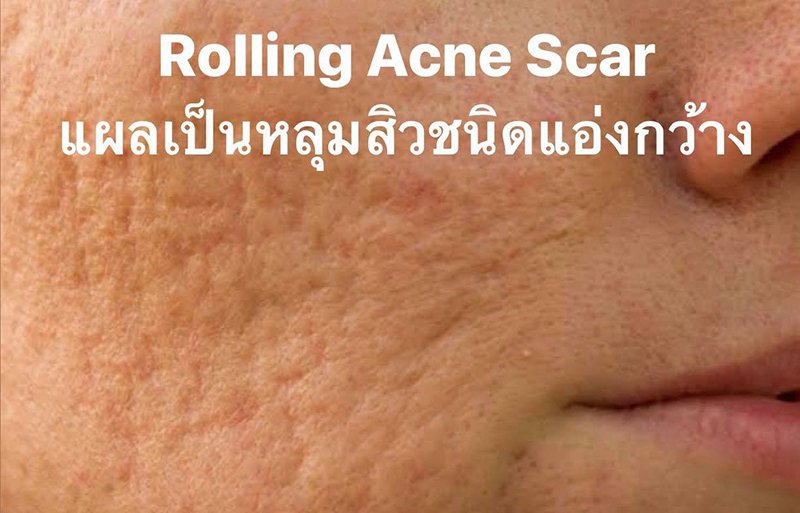 Rolling Acne Scars รอยแผลเป็นหลุมจากสิวที่มีลักษณะกว้าง และตื้น คล้ายกระทะ