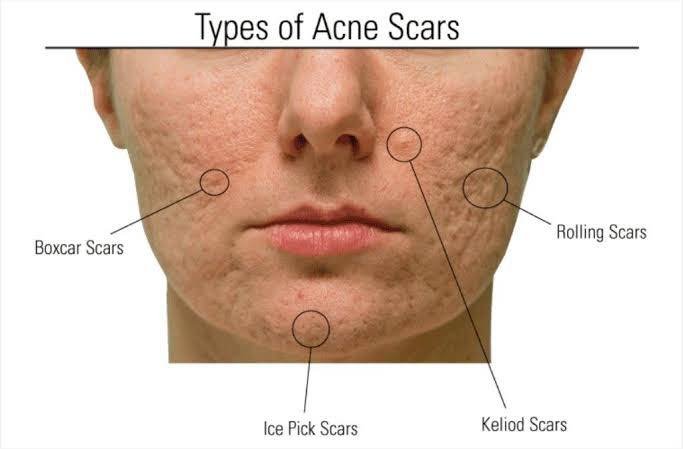 Rolling Acne Scars รอยแผลเป็นหลุมจากสิวที่มีลักษณะกว้าง และตื้น คล้ายกระทะ