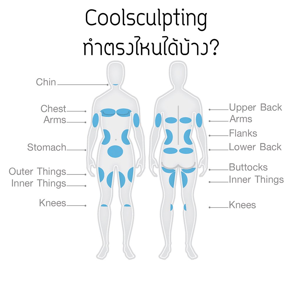 การสลายไขมันด้วยความเย็น  Cryolipolysis 