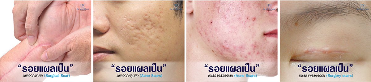 DeMed Clinic By Dr.Suparuj“รอยแผลเป็น”  แผลจากศัลยกรรม (Surgery scars)@demedclinicwww.demedclinic.com063-959-4392 DeMed Clinic By Dr.Suparuj“รอยแผลเป็น”  แผลจากสิวอักเสบ (Acne Scars)@demedclinicwww.demedclinic.com063-959-4392 DeMed Clinic By Dr.Suparuj“รอยแผลเป็น”  แผลจากหลุมสิว (Acne Scars)@demedclinicwww.demedclinic.com063-959-4392 “รอยแผลเป็น”  แผลจากผ่าตัด (Surgical Scar)DeMed Clinic By Dr.Suparuj@demedclinicwww.demedclinic.com063-959-4392 หมดปัญหาผิวไม่เรียบ ไม่สวยจากรอยแผลเป็น หลุมสิว หรือรอยแผลทุกชนิด ที่ทำให้ผิวเป็นรอยรักษาให้ดีขึ้นได้ด้วยเทคโนโลยีใหม่ล่าสุดด้านเทคนิคพิเศษเฉพาะที่ DeMed ClinicPicosecond Laserรักษารอยแผลเป็นด้วยนวัตกรรมDeMed Clinic By Dr.Suparuj@demedclinicwww.demedclinic.com063-959-4392 “ รักษาแผลเป็น สามารถรักษาให้จางลงได้และผิวเรียบเนียนขึ้นได้ครับ แต่แผลเป็นทุกชนิดจะหายได้หรือเนียนเรียบหายเป็นผิวปกติ หรือหายได้ 100% นั้น ขึ้นอยู่กับผลลัพธ์ที่อาจแตกต่างกันไปแล้วแต่บุคคล ซึ่งการรักษาแผลเป็นด้วย Picosecond Laser หรือโปรแกรมพิเศษนั้น รักษายิ่งเร็วยิ่งได้ผลดีครับ ” หมอรุจ By DeMed Clinic 