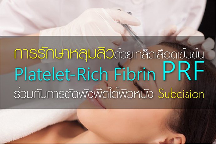 การรักษาหลุมสิวด้วยเกล็ดเลือดเข้มข้น Platelet-Rich Fibrin PRF ร่วมกับการตัดพังผืดใต้ผิวหนัง Subcision 