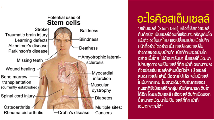 What is stem cell therapy??? 
