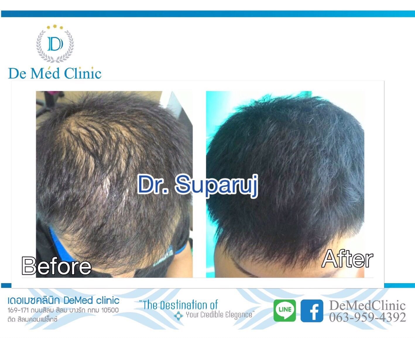 “De Med Hair & Scalp Care Treatment” ทรีทเมนท์ผมและหนังศีรษะสูตรพิเศษโดย De Med Clinic 