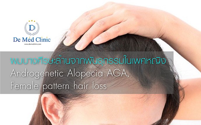 ผมบางศีรษะล้านจากพันธุกรรมในเพศหญิง  Androgenetic Alopecia AGA, Female pattern hair loss