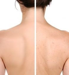 Body Acne Treatment Program by De Med Clinic โปรแกรมดูแลรักษาสิวที่ชำตัวและหลัง
