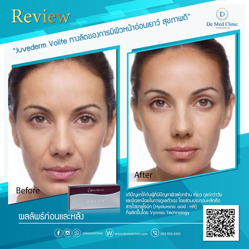 Juvederm Volite 