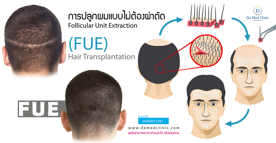การปลูกผมแบบไม่ต้องผ่าตัด Follicular Unit Extraction (FUE) Hair Transplantation 