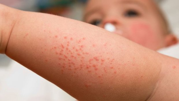 โรคผื่นภูมิแพ้ผิวหนังในเด็ก Atopic Dermatitis (AD)
