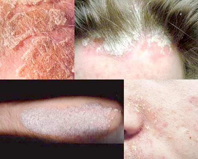 โรคผิวหนังอักเสบเซ็บเดิร์ม Seborrheic Dermatitis หรือโรคผื่นแพ้ต่อมไขมัน คืออะไร รักษาได้อย่างไร