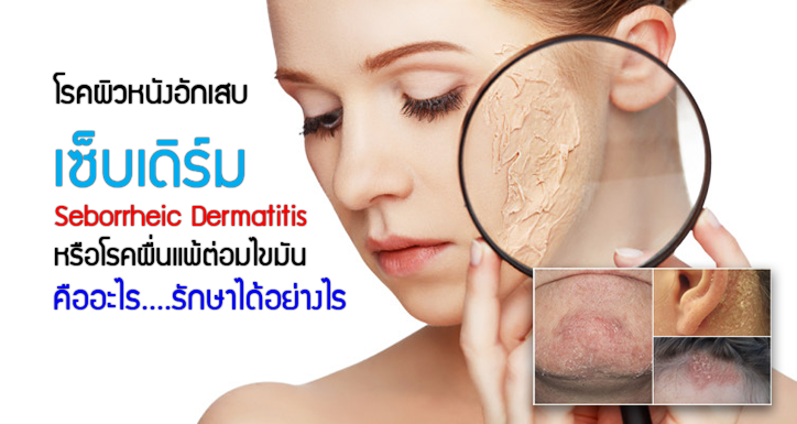 โรคผิวหนังอักเสบเซ็บเดิร์ม Seborrheic Dermatitis หรือโรคผื่นแพ้ต่อมไขมัน คืออะไร รักษาได้อย่างไร