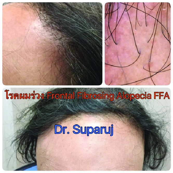 โรค ผมร่วง Frontal Fibrosing Alopecia