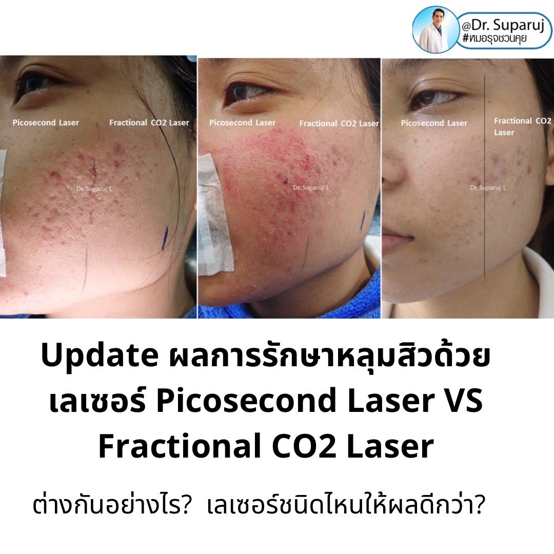 Update ผลการรักษาหลุมสิวด้วยเลเซอร์ Picosecond Laser VS Fractional CO2 Laser ต่างกันอย่างไร? เลเซอร์ชนิดไหนให้ผลดีกว่า? Update ผลการรักษาหลุมสิวด้วยเลเซอร์ Picosecond Laser VS Fractional CO2 Laser ต่างกันอย่างไร? เลเซอร์ชนิดไหนให้ผลดีกว่า?