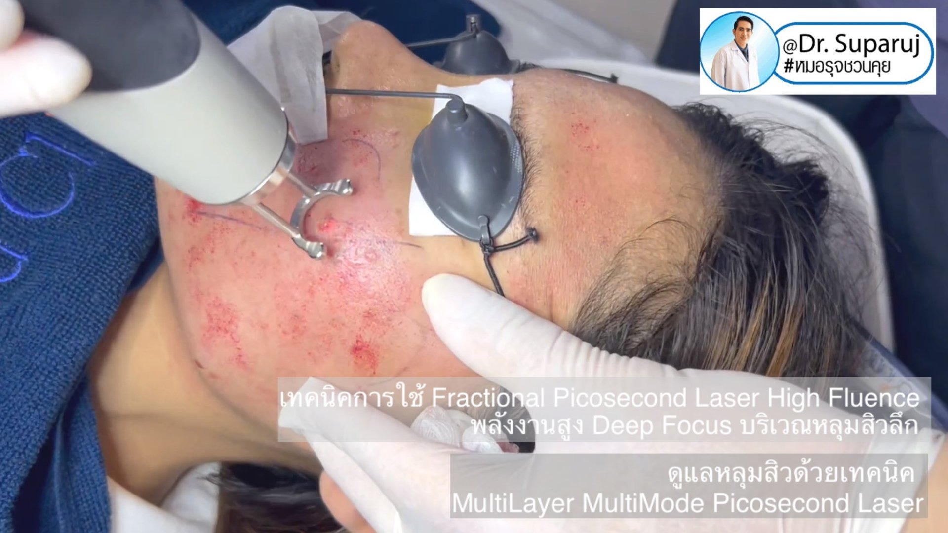 เทคนิครักษาหลุมสิวด้วยเลเซอร์ MultiLayer MultiMode Picosecond Laser เทคนิครักษาหลุมสิวด้วยเลเซอร์ MultiLayer MultiMode Picosecond Laser