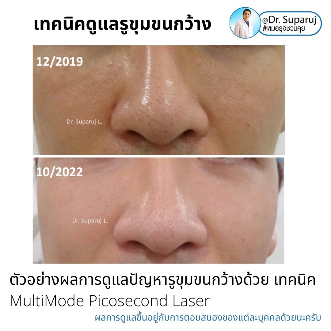 แนะนำเทคนิคดูแลรูขุมขนกว้าง: ตัวอย่างผลการดูแลรูขุมขนกว้าง Enlarged Facial Pore ด้วย MultiMode Picosecond Laser แนะนำเทคนิคดูแลรูขุมขนกว้าง: ตัวอย่างผลการดูแลรูขุมขนกว้าง Enlarged Facial Pore ด้วย MultiMode Picosecond Laser