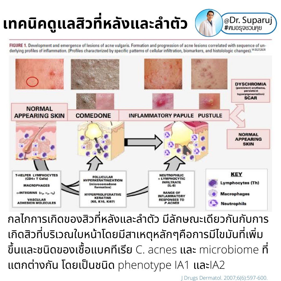 สิวที่หลัง และลำตัว Truncal & Body Acne เกิดจากอะไรและดูแลรักษาได้อย่างไร ? (Update + รีวิว)