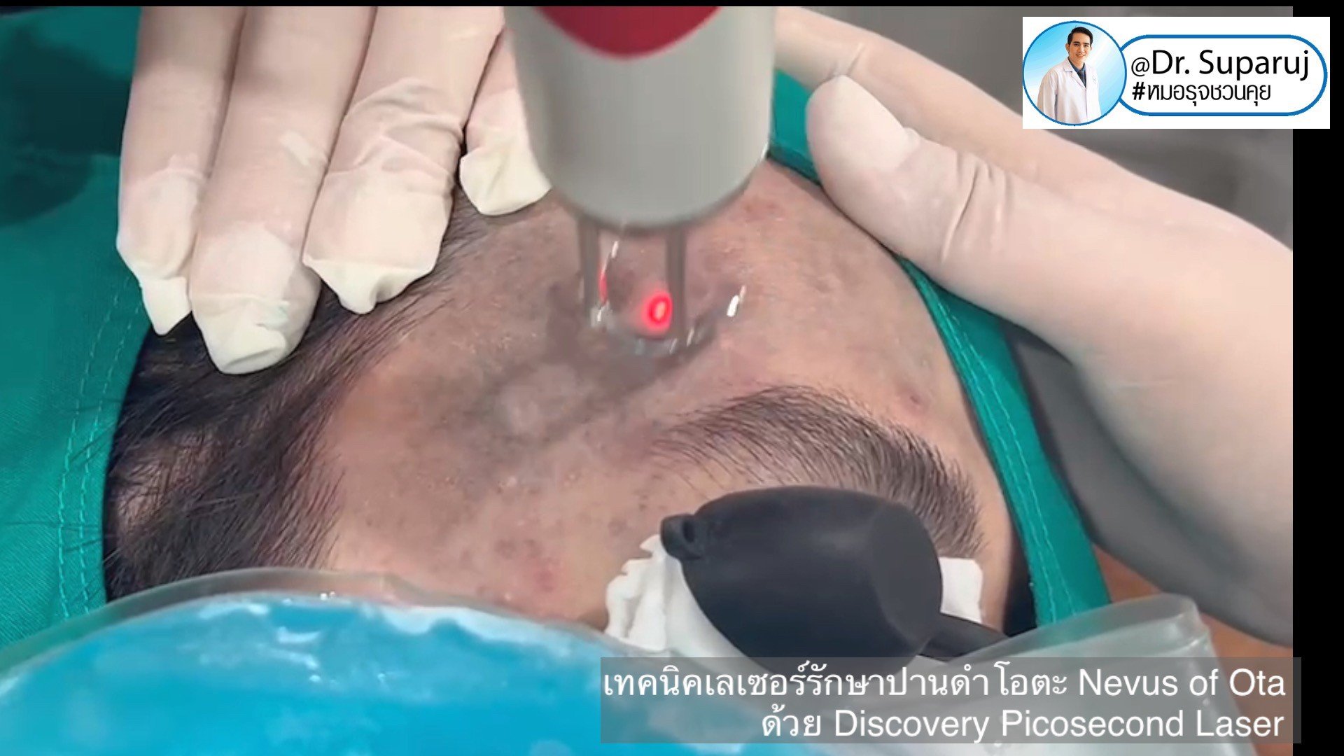 เทคนิคเลเซอร์รักษาปานดำโอตะ Nevus of Ota ด้วย Discovery Picosecond Laser เลเซอร์ปานดำ l หมอรุจชวนคุย เทคนิคเลเซอร์รักษาปานดำโอตะ Nevus of Ota ด้วย Discovery Picosecond Laser เลเซอร์ปานดำ l หมอรุจชวนคุย