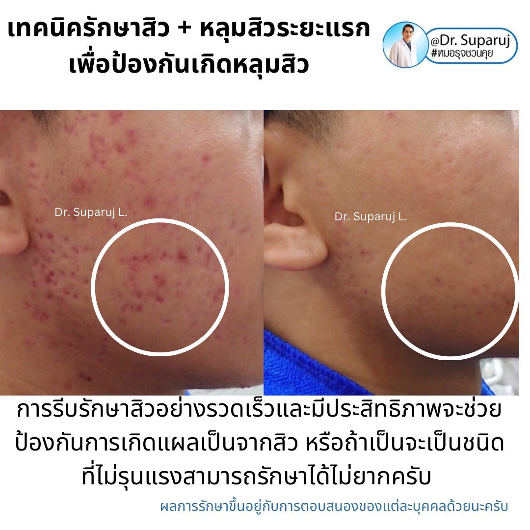 เป็นสิว + มีรอยดำจากสิว Acne dark spot ใช้ยา + สกินแคร์อะไร?จะได้ประโยชน์ดูแลทั้งสองอย่าง