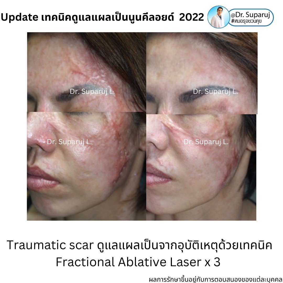 แผลเป็นนูนคีลอยคีลอยด์สามารถรักษาด้วยโดยวิธีผ่าตัดออกได้ไหม ? แผลเป็นนูนคีลอยคีลอยด์สามารถรักษาด้วยโดยวิธีผ่าตัดออกได้ไหม ?