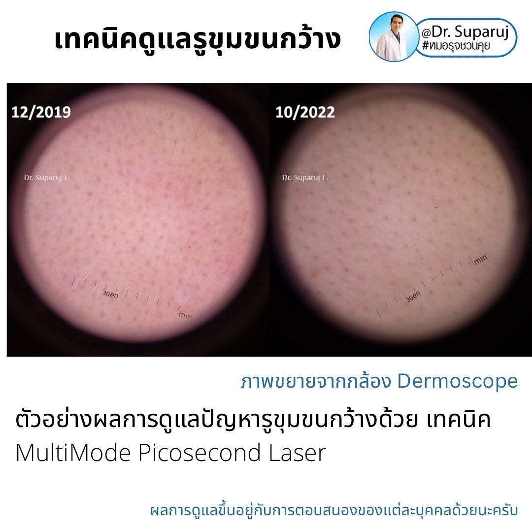 แนะนำเทคนิคดูแลรูขุมขนกว้าง: ตัวอย่างผลการดูแลรูขุมขนกว้าง Enlarged Facial Pore ด้วย MultiMode Picosecond Laser แนะนำเทคนิคดูแลรูขุมขนกว้าง: ตัวอย่างผลการดูแลรูขุมขนกว้าง Enlarged Facial Pore ด้วย MultiMode Picosecond Laser
