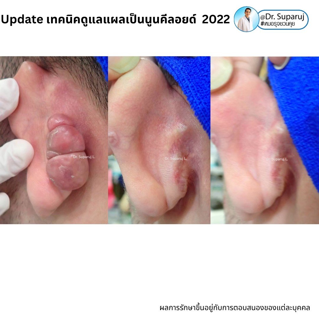 Update เทคนิคดูแลแผลเป็นนูนคีลอยด์ 2022 Update เทคนิคดูแลแผลเป็นนูนคีลอยด์ 2022