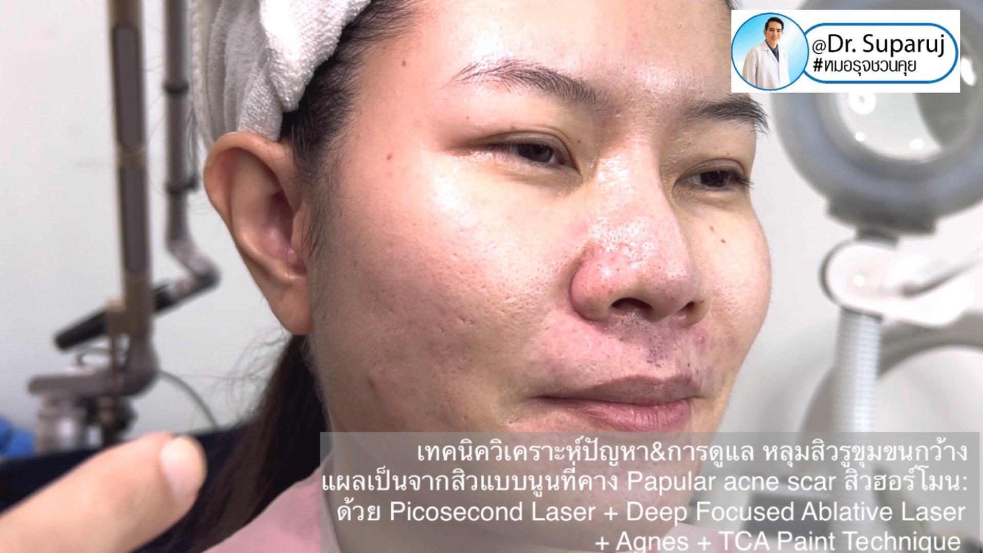 เทคนิควิเคราะห์ปัญหา & รักษาหลุมสิว รูขุมขนกว้าง แผลเป็นจากสิวแบบนูน Papular acne scar สิวฮอร์โมน: ด้วย Picosecond Laser + Deep Focused Ablative Laser + Agnes + TCA Paint Technique เทคนิควิเคราะห์ปัญหา & รักษาหลุมสิว รูขุมขนกว้าง แผลเป็นจากสิวแบบนูน Papular acne scar สิวฮอร์โมน: ด้วย Picosecond Laser + Deep Focused Ablative Laser + Agnes + TCA Paint Technique