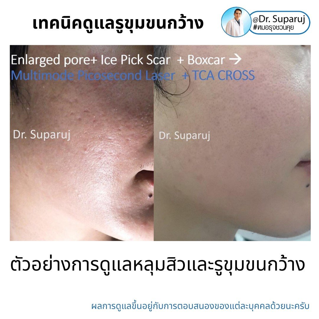 เทคนิควิเคราะห์ & รักษาขุมขนกว้าง Enlarged Facial Pore ด้วยกล้อส่องขยายพิเศษทางผิวหนัง Dermoscopy