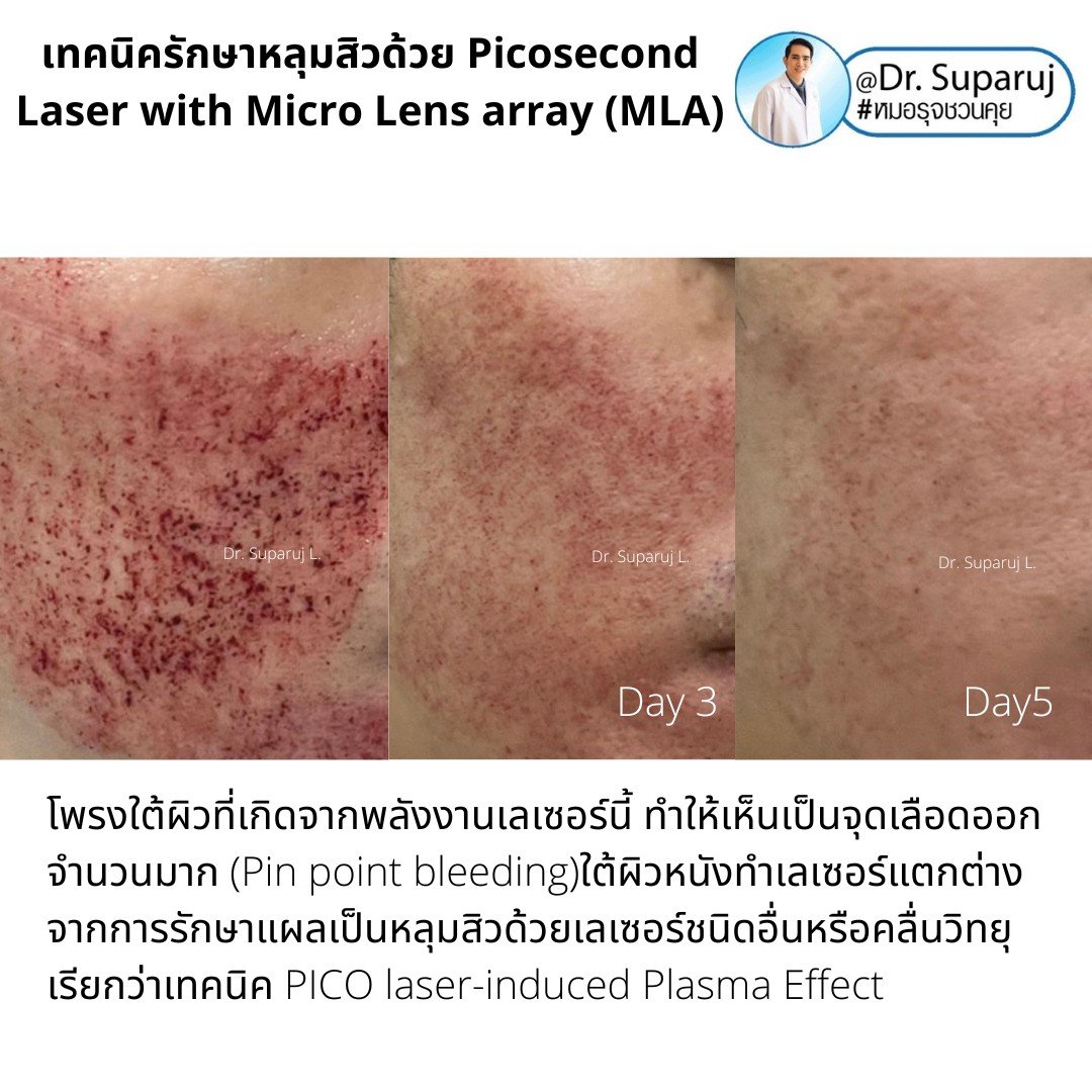 แนะนำเทคนิคดูแลหลุมสิว: Picosecond Laser แต่ละ Mode แตกต่างกันอย่างไร ?  ใช้ดูแลปัญหาไหน ชนิดไหนดีกว่ากัน: Full Beam/ Fractional MLA ?/ High Fluence/ Low Fluence