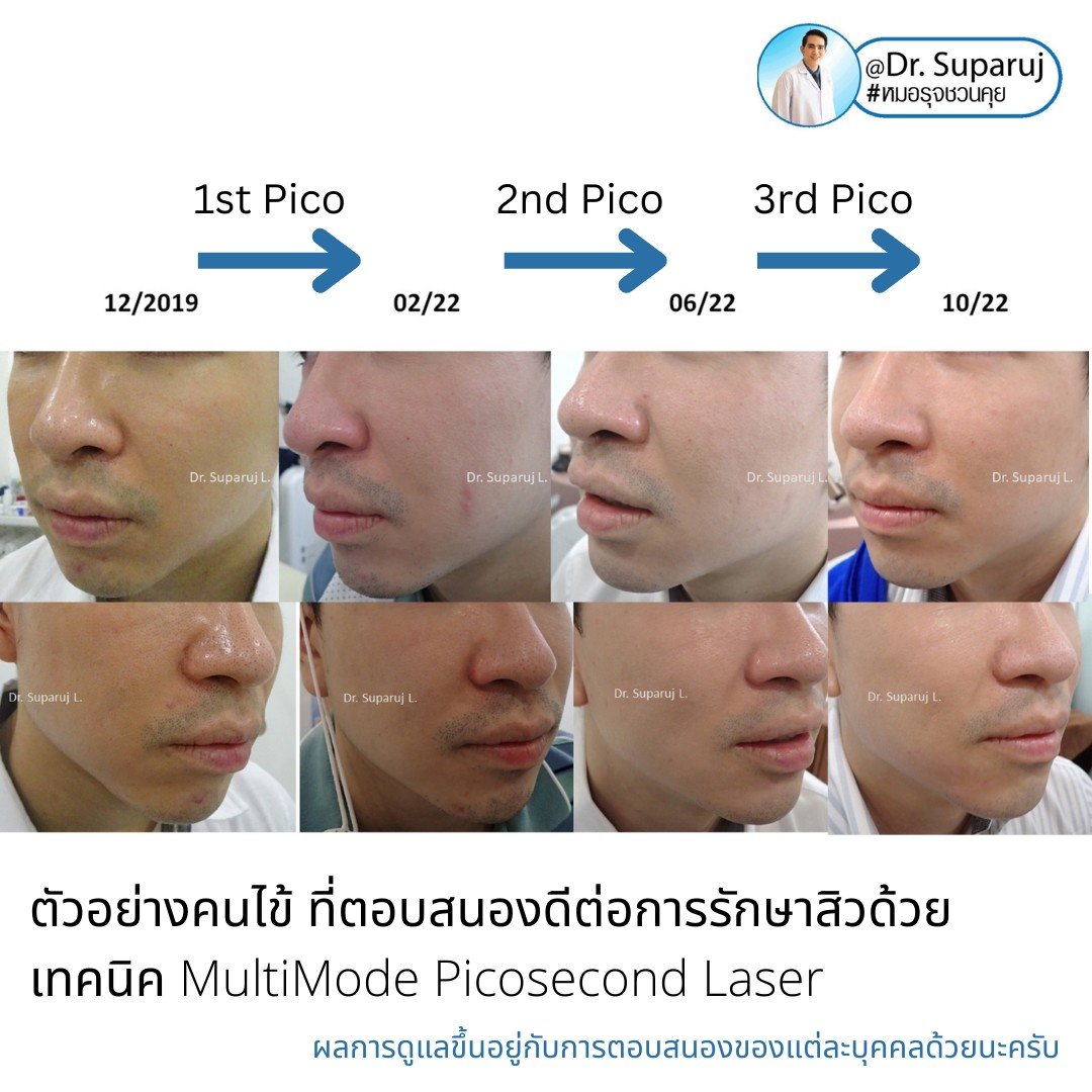 ผลการรักษาหลุมสิวด้วย Picosecond Laser VS InfiniRF Microneedle แตกต่างกันอย่างไร อะไรมีประสิทธิภาพดีกว่า ? ผลการรักษาหลุมสิวด้วย Picosecond Laser VS InfiniRF Microneedle แตกต่างกันอย่างไร อะไรมีประสิทธิภาพดีกว่า ?
