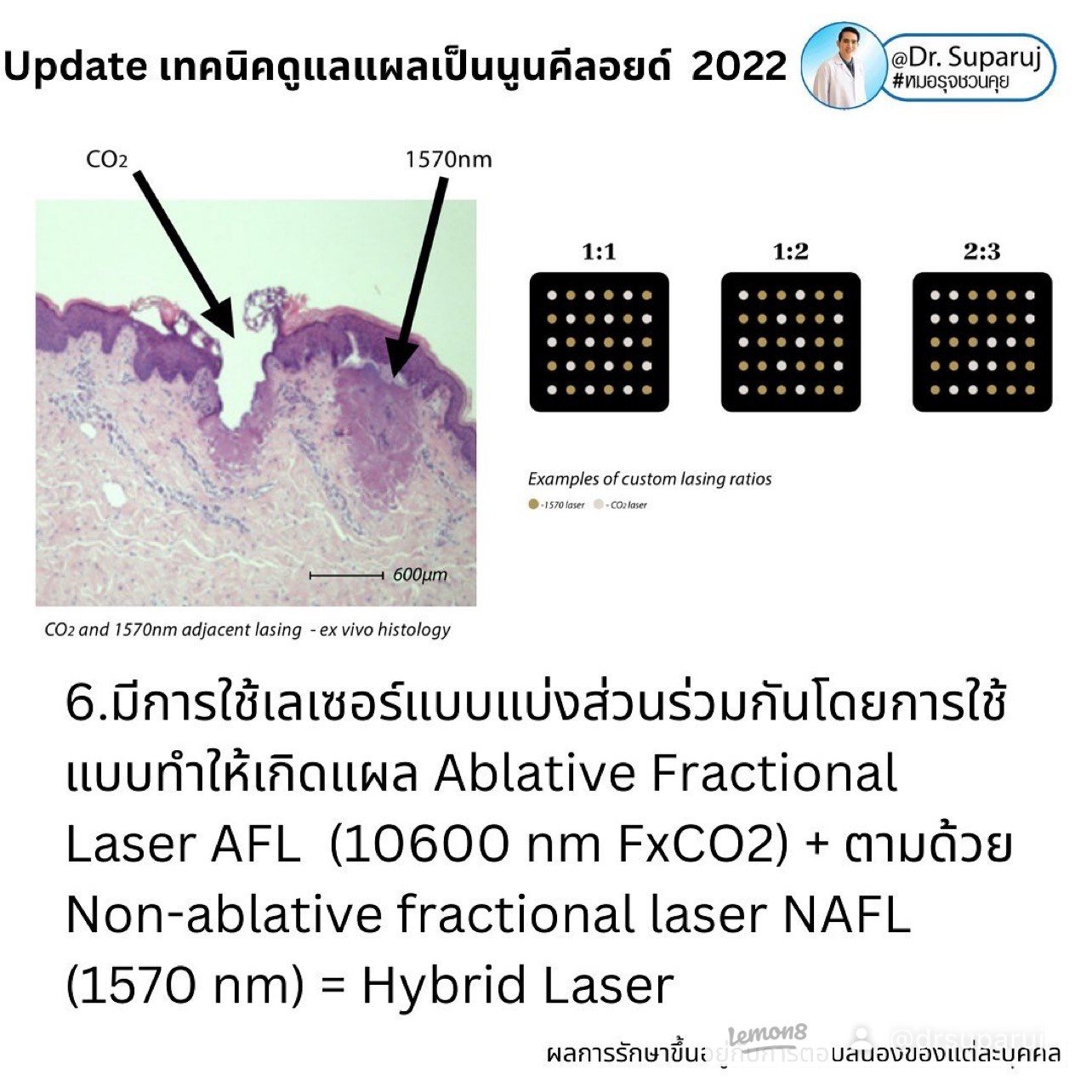 แผลเป็นนูนคีลอยคีลอยด์สามารถรักษาด้วยโดยวิธีผ่าตัดออกได้ไหม ?