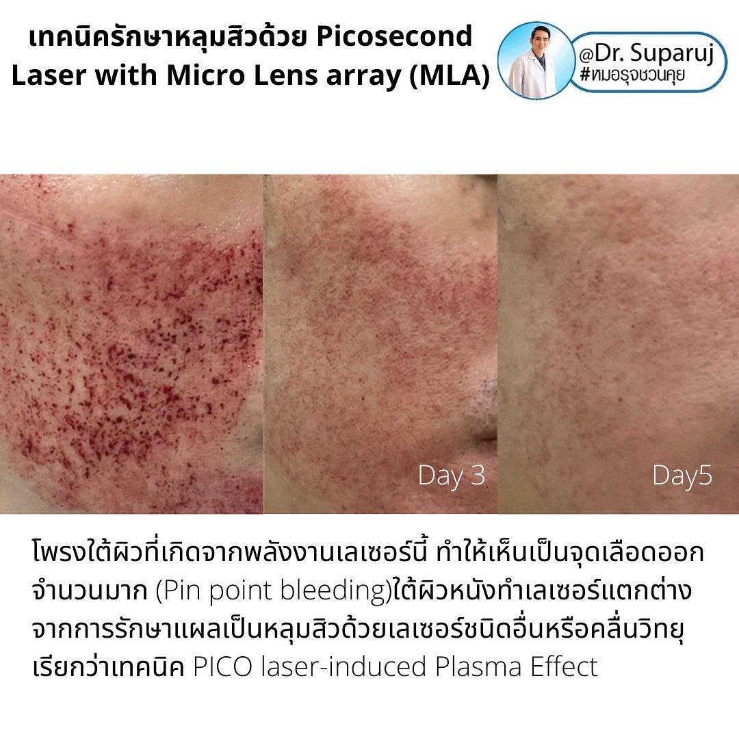 Update ผลการรักษาหลุมสิวด้วย Picosecond Laser VS InfiniRF Microneedle แตกต่างกันอย่างไร อันไหนมีประสิทธิภาพดีกว่า ? Update ผลการรักษาหลุมสิวด้วย Picosecond Laser VS InfiniRF Microneedle แตกต่างกันอย่างไร อันไหนมีประสิทธิภาพดีกว่า ?