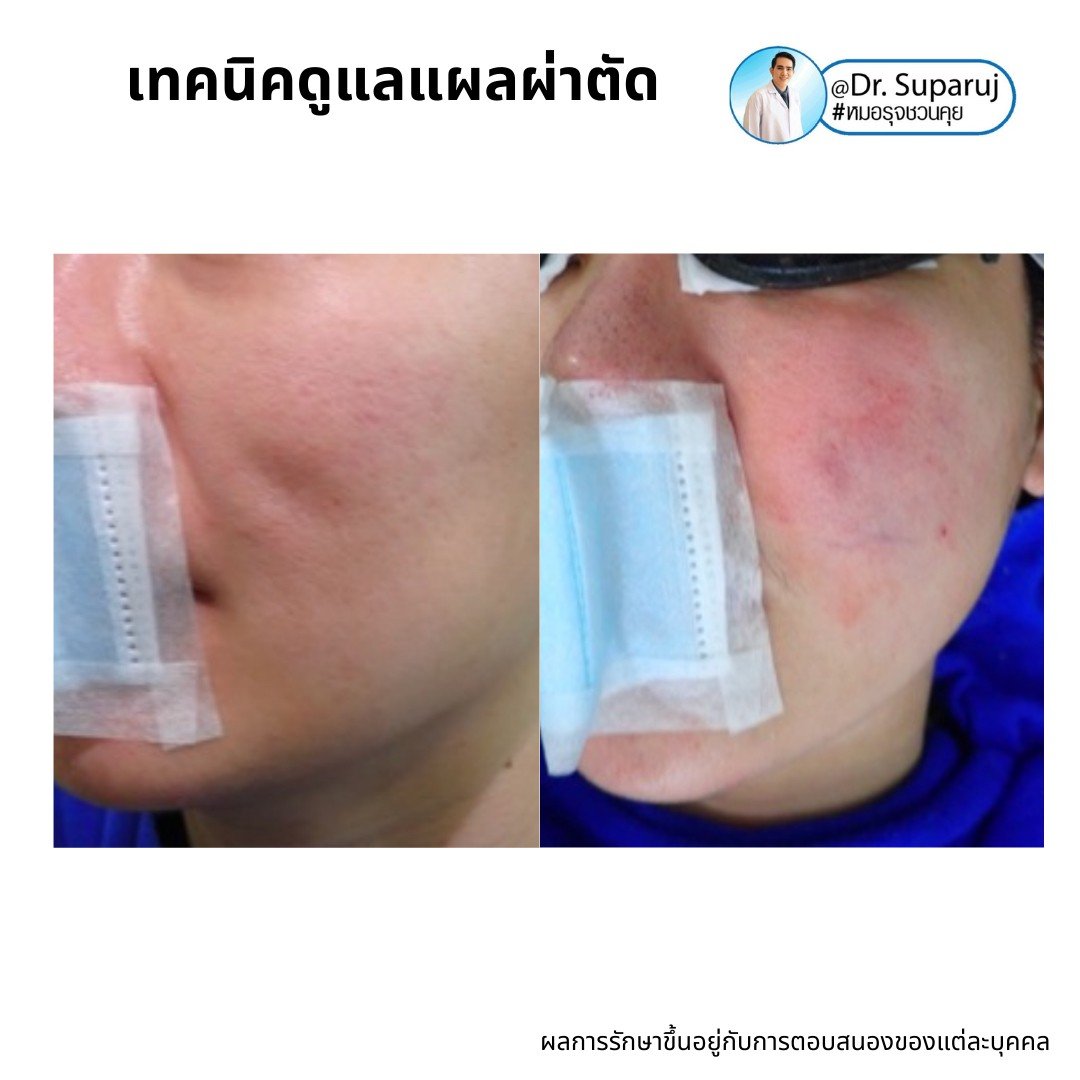 Update เทคนิคดูแลแผลเป็นนูนคีลอยด์ 2022 Update เทคนิคดูแลแผลเป็นนูนคีลอยด์ 2022