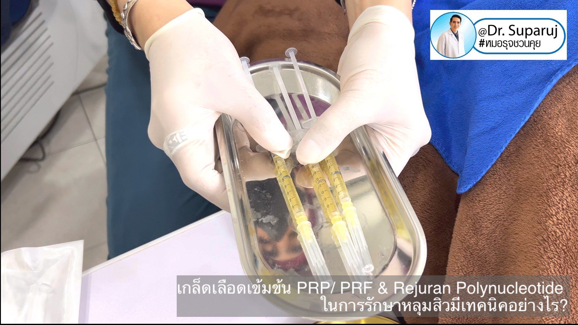 Update เทคนิคดูแลหลุมสิวด้วย Rejuran และ เกล็ดเลือดเข้มข้น PRP/PRF มีเทคนิคอย่างไร? เทคนิคไหนได้ผลดีกว่า ? Update เทคนิคดูแลหลุมสิวด้วย Rejuran และ เกล็ดเลือดเข้มข้น PRP/PRF มีเทคนิคอย่างไร? เทคนิคไหนได้ผลดีกว่า ?