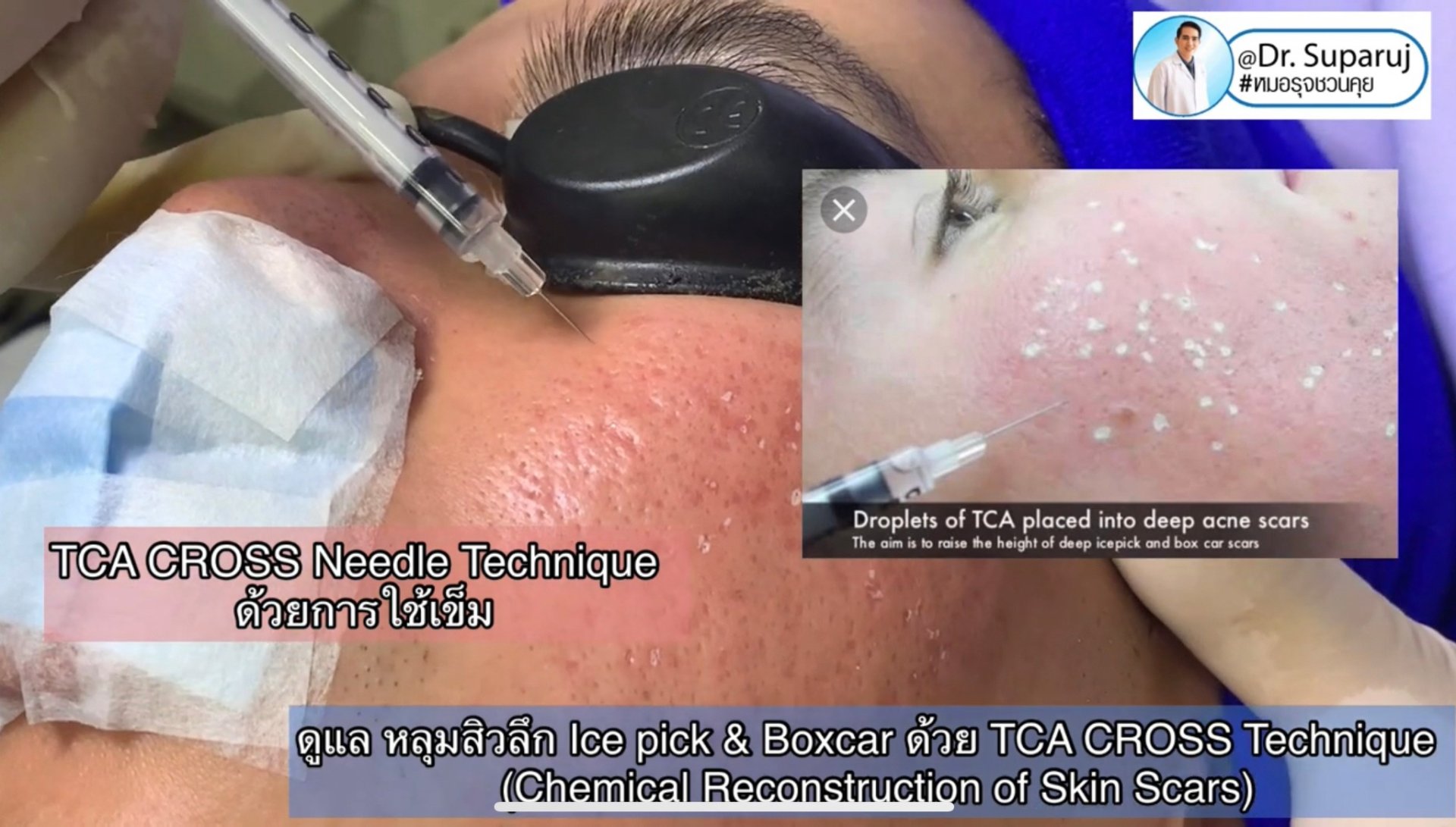 รักษาหลุมสิวด้วยการแต้มกรด TCA แล้วเกิดเป็นรอยดำ เกิดจากอะไรได้บ้าง? รักษาหลุมสิวด้วยการแต้มกรด TCA แล้วเกิดเป็นรอยดำ เกิดจากอะไรได้บ้าง?