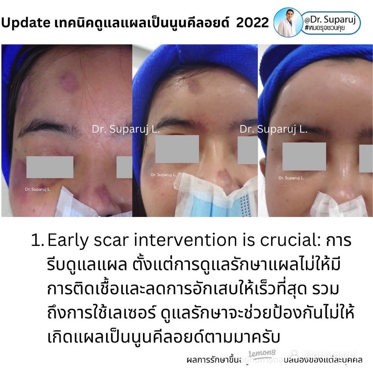 แผลเป็นนูนคีลอยคีลอยด์สามารถรักษาด้วยโดยวิธีผ่าตัดออกได้ไหม ? แผลเป็นนูนคีลอยคีลอยด์สามารถรักษาด้วยโดยวิธีผ่าตัดออกได้ไหม ?