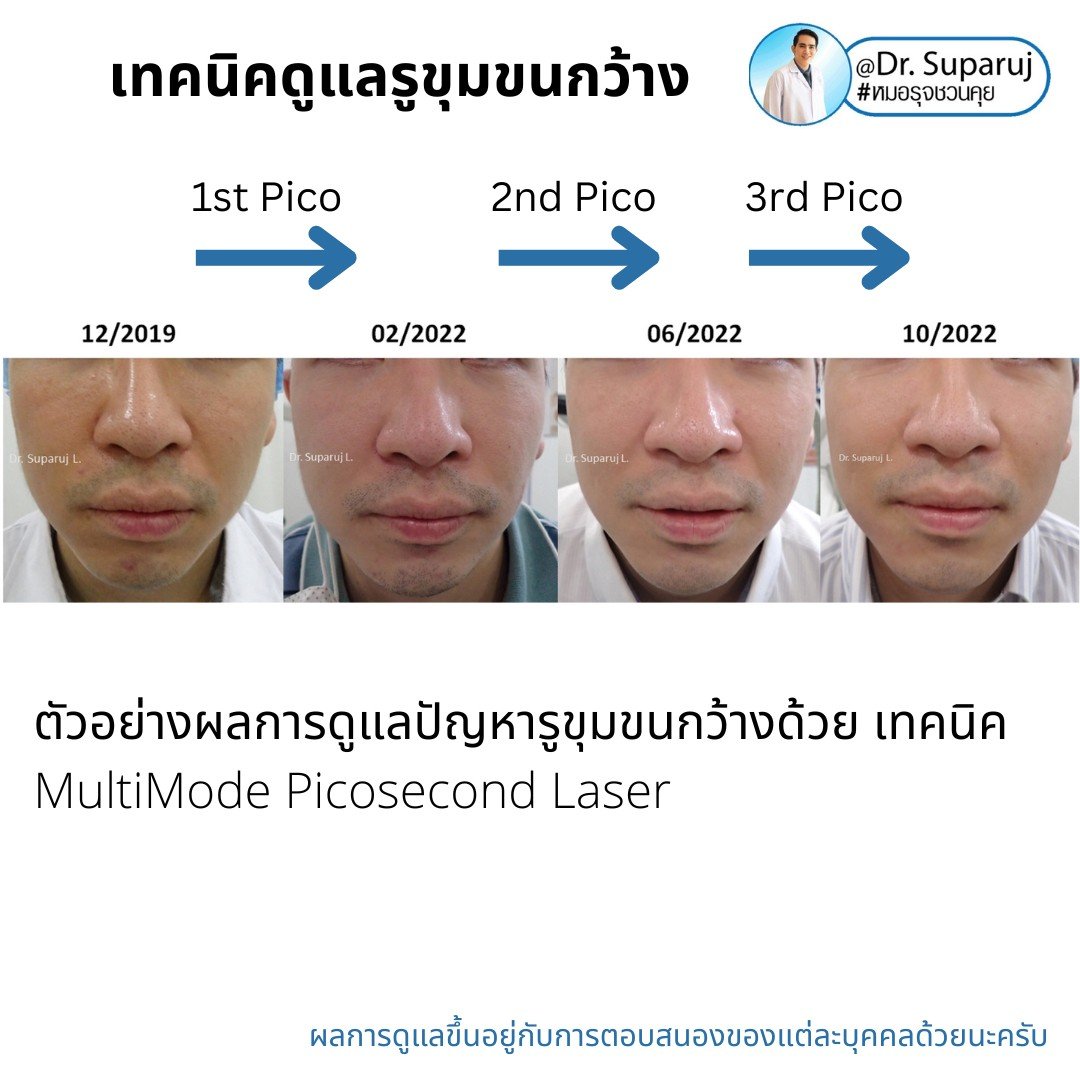 แนะนำเทคนิคดูแลรูขุมขนกว้าง: ตัวอย่างผลการดูแลรูขุมขนกว้าง Enlarged Facial Pore ด้วย MultiMode Picosecond Laser แนะนำเทคนิคดูแลรูขุมขนกว้าง: ตัวอย่างผลการดูแลรูขุมขนกว้าง Enlarged Facial Pore ด้วย MultiMode Picosecond Laser