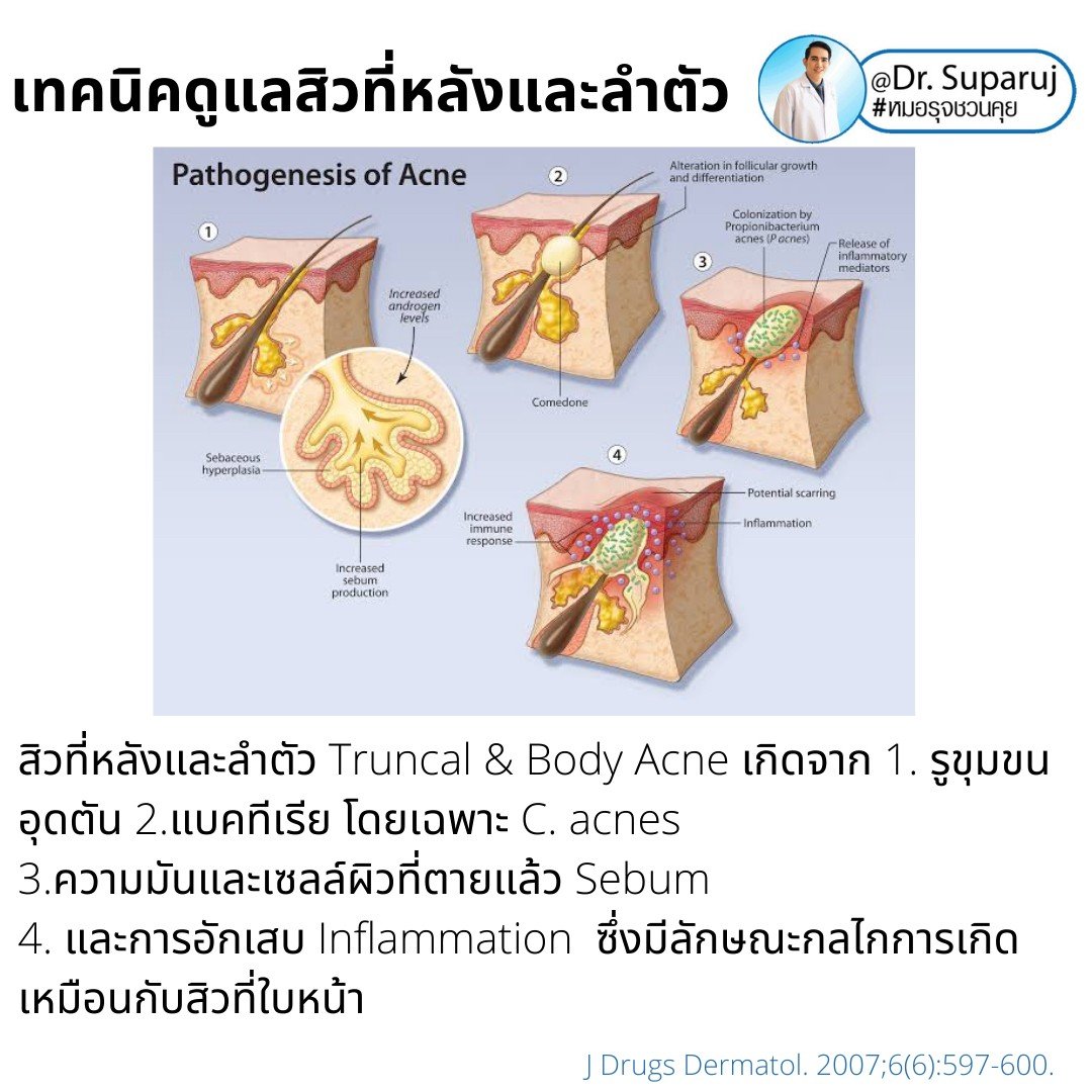 การรักษาเสริม: การรักษาเสริมด้วยหัตถการต่างๆ