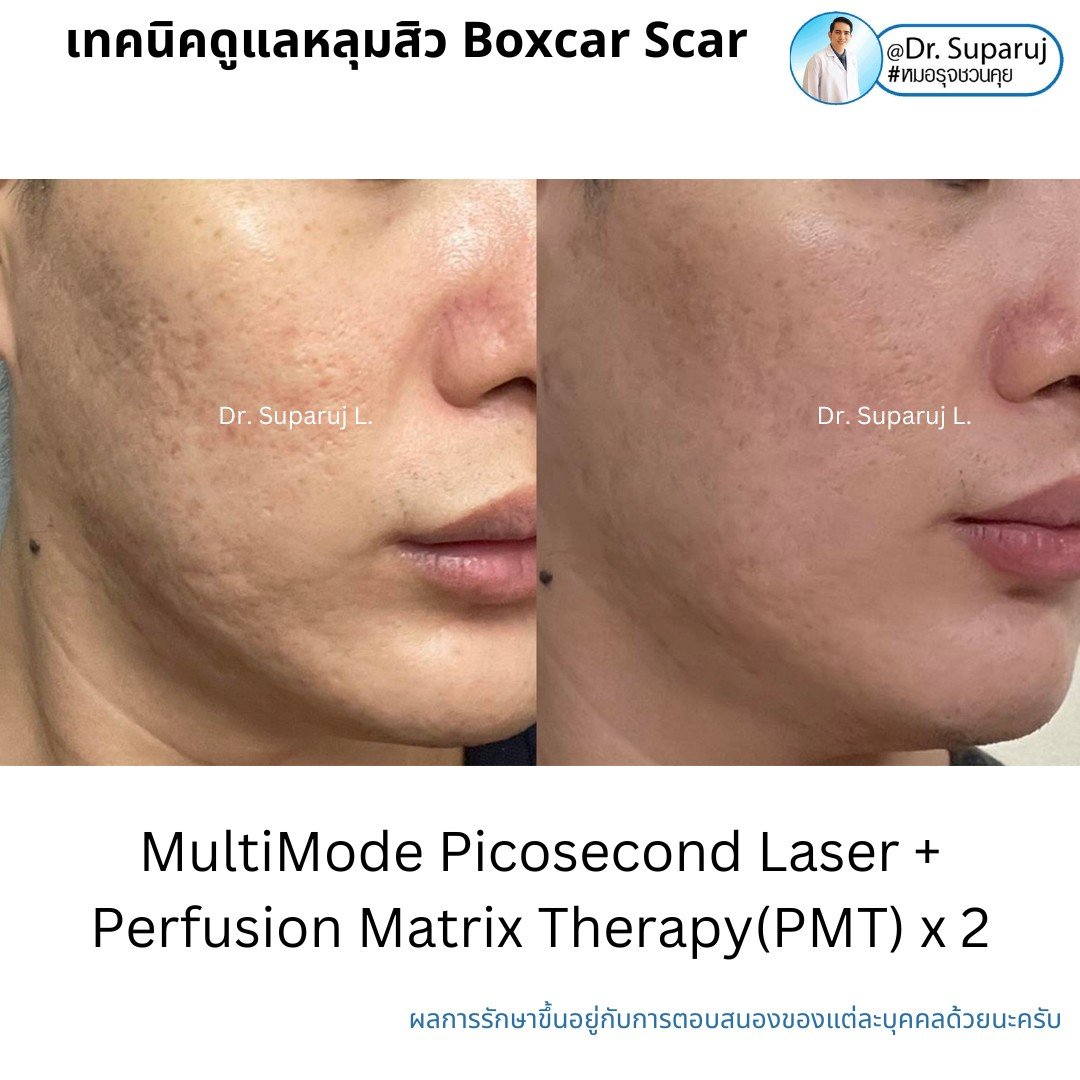 เทคนิคการดูแลหลุมสิว: ตัวอย่างการดูแลหลุมสิวแบบขอบชัดและแบบยุบตัวด้วยการใช้ Picosecond Laser + Perfusion Matrix Therapy เทคนิคการดูแลหลุมสิว: ตัวอย่างการดูแลหลุมสิวแบบขอบชัดและแบบยุบตัวด้วยการใช้ Picosecond Laser + Perfusion Matrix Therapy