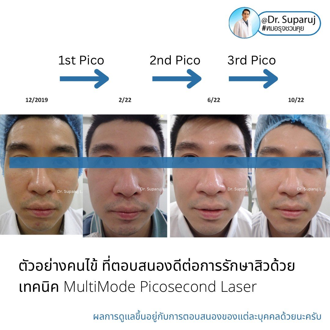 หลุมสิวจำเป็นต้องรักษากี่ครั้ง? ทำไมต้องรักษาหลายครั้ง ? หลุมสิวจำเป็นต้องรักษากี่ครั้ง? ทำไมต้องรักษาหลายครั้ง ?