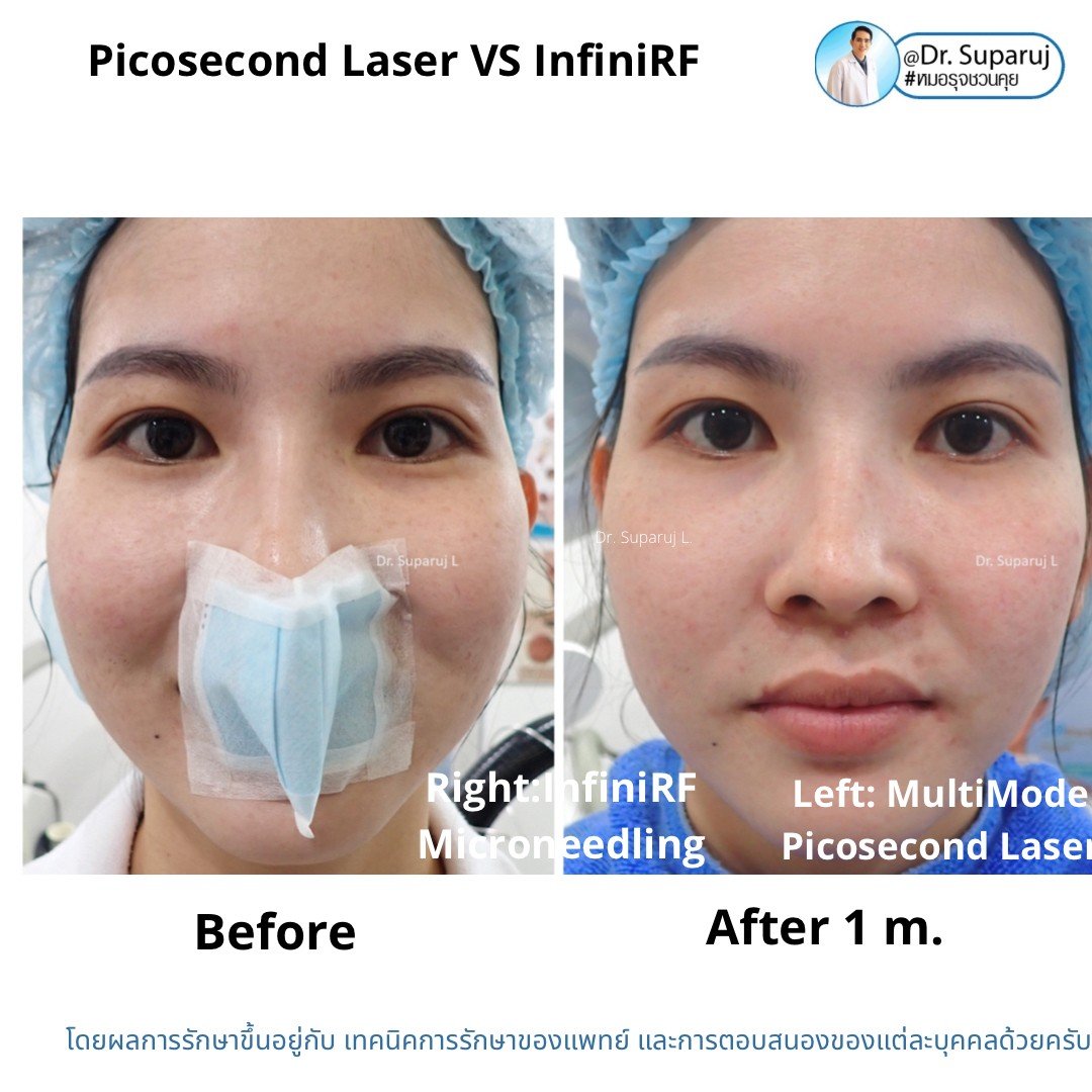 Update ผลการรักษาหลุมสิวด้วย Picosecond Laser VS InfiniRF Microneedle แตกต่างกันอย่างไร อันไหนมีประสิทธิภาพดีกว่า ?