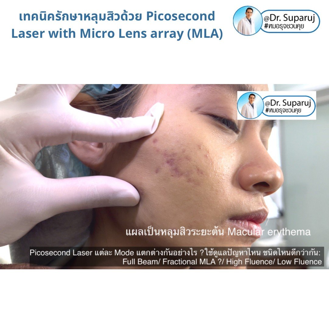 แนะนำเทคนิคดูแลหลุมสิว: Picosecond Laser แต่ละ Mode แตกต่างกันอย่างไร ? ใช้ดูแลปัญหาไหน ชนิดไหนดีกว่ากัน: Full Beam/ Fractional MLA ?/ High Fluence/ Low Fluence แนะนำเทคนิคดูแลหลุมสิว: Picosecond Laser แต่ละ Mode แตกต่างกันอย่างไร ? ใช้ดูแลปัญหาไหน ชนิดไหนดีกว่ากัน: Full Beam/ Fractional MLA ?/ High Fluence/ Low Fluence