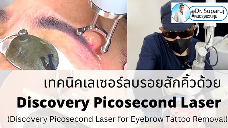 เทคนิคเลเซอร์ลบรอยสักคิ้วด้วย Discovery Picosecond Laser (Discovery Picosecond Laser for Eyebrow Tattoo Removal)