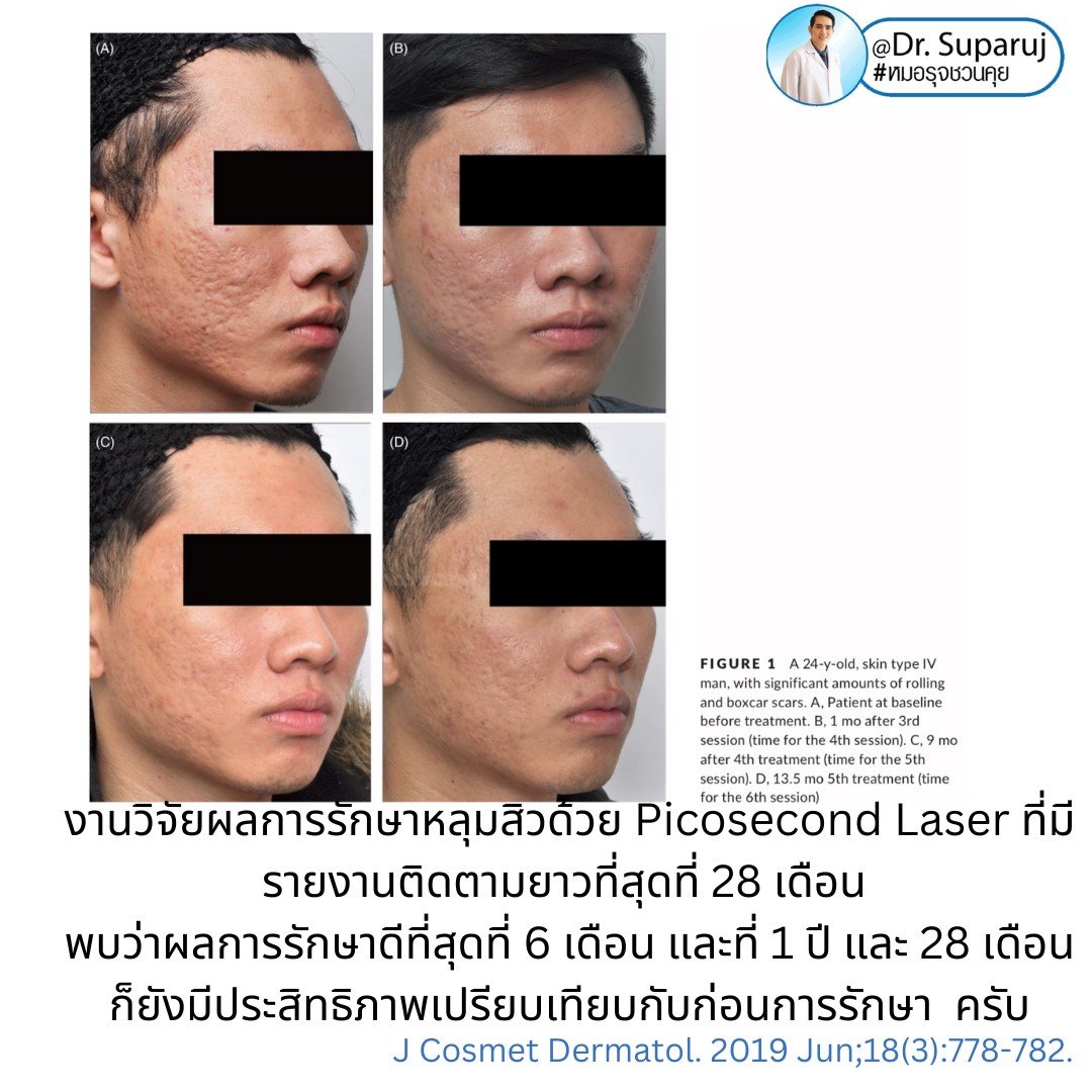 Q: หลังรักษาหลุมสิวด้วยเลเซอร์หรือเทคนิคต่างๆ หลังจากรักษาเรียบร้อยแล้ว จะมีโอกาสกลับมายุบตัว หรือหลุมสิวจะกลับมาแบบเดิมไหม? Q: หลังรักษาหลุมสิวด้วยเลเซอร์หรือเทคนิคต่างๆ หลังจากรักษาเรียบร้อยแล้ว จะมีโอกาสกลับมายุบตัว หรือหลุมสิวจะกลับมาแบบเดิมไหม?