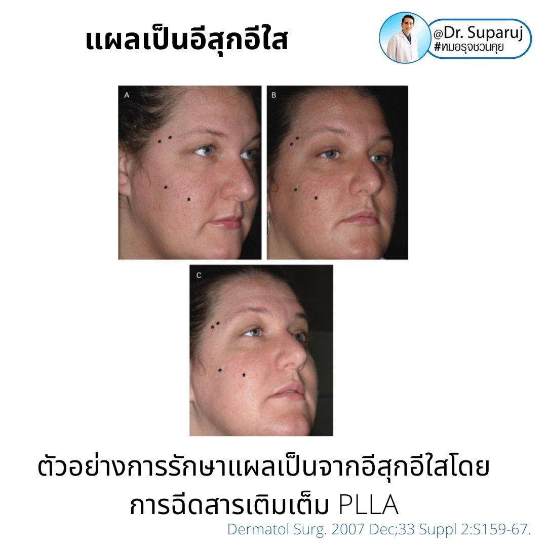แผลเป็นยุบตัวจากอีสุกอีใส Chicken pox scars ดูแลได้อย่างไร ? แผลเป็นยุบตัวจากอีสุกอีใส Chicken pox scars ดูแลได้อย่างไร ?