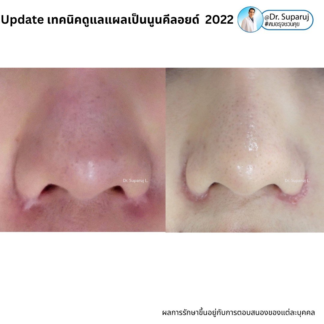 Update เทคนิคดูแลแผลเป็นนูนคีลอยด์ 2022 Update เทคนิคดูแลแผลเป็นนูนคีลอยด์ 2022