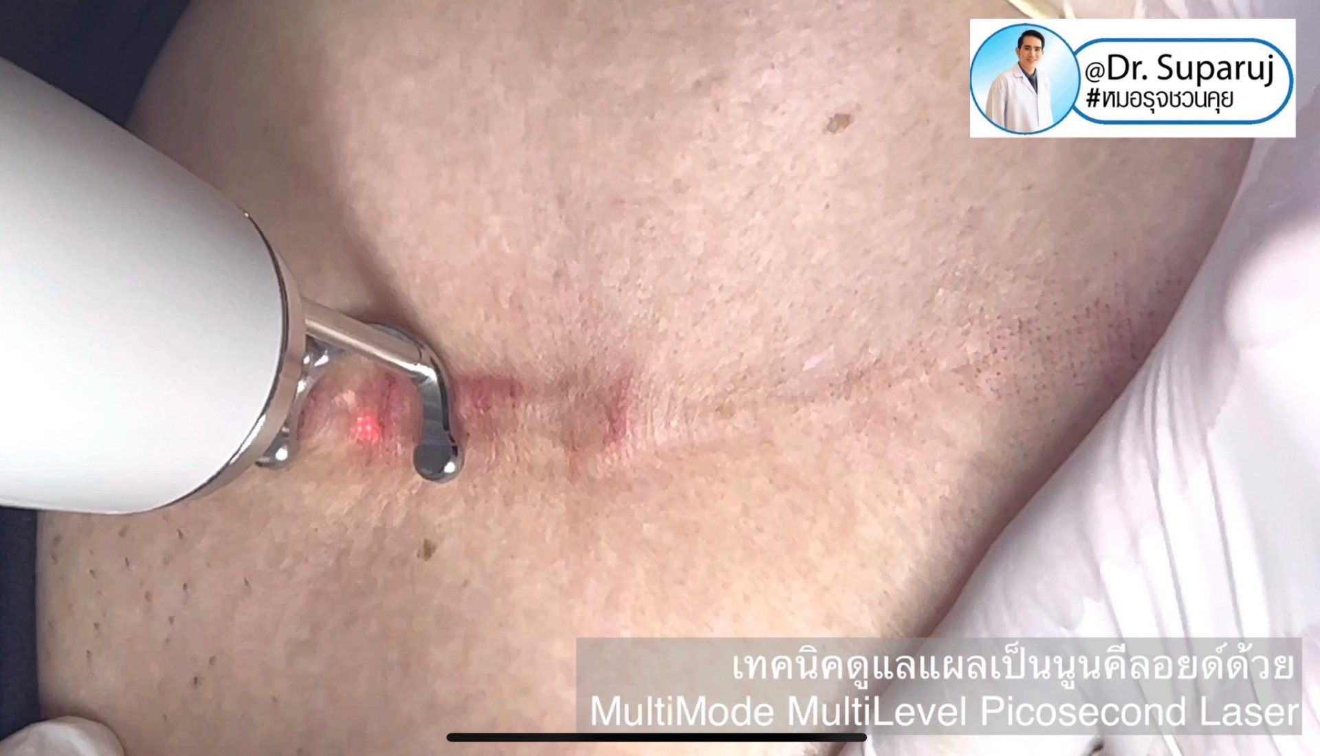 เทคนิคดูแลแผลเป็นด้วยเทคนิค MultiMode MultiLayer Discovery Picosecond Laser with Micro Lens Array MLA เทคนิคดูแลแผลเป็นด้วยเทคนิค MultiMode MultiLayer Discovery Picosecond Laser with Micro Lens Array MLA